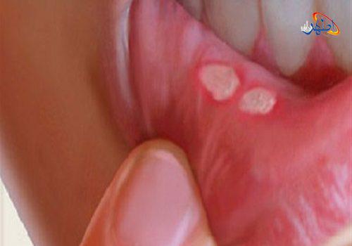 آفت دهان چیست و چگونه درمان می شود؟